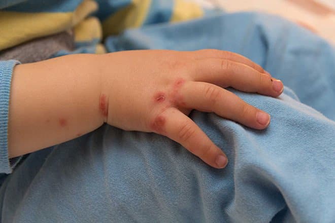 Bệnh tay chân miệng ở trẻ bao lâu thì khỏi?