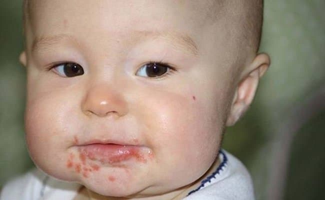 Thời gian ủ bệnh và khả năng lây lan của bệnh tay chân miệng
