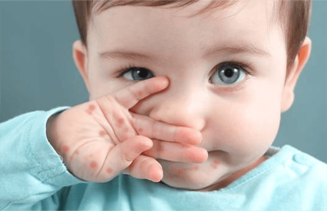 Hướng dẫn Chăm sóc da, tắm cho bé khi bị tay chân miệng