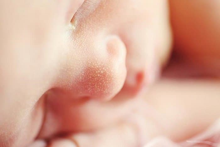 Mụn trứng cá ở trẻ sơ sinh những điều cần biết