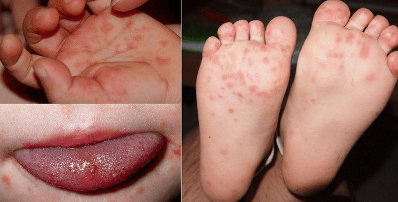 Nên áp dụng các biện pháp dân gian để chăm sóc trẻ bị tay chân miệng hay không?
