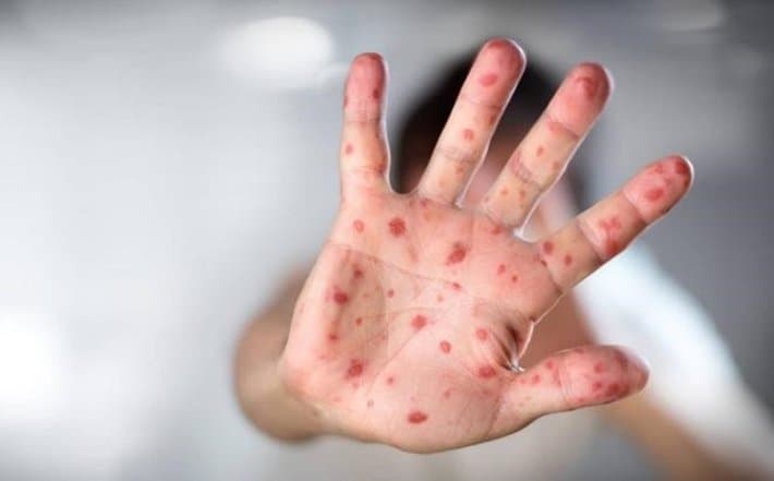 Dấu hiệu lâm sàng 4 cấp độ của bệnh tay chân miệng mọi người cần biết