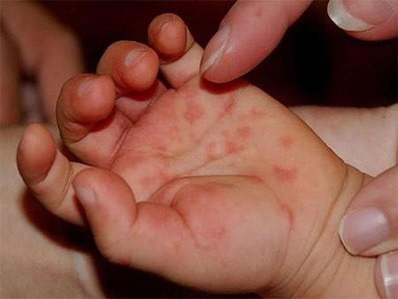 Chăm sóc trẻ bị tay chân miệng tại nhà để ngăn ngừa bội nhiễm bóng nước