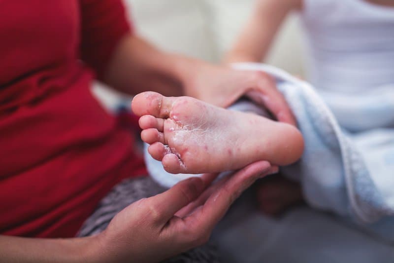 Nguyên nhân, triệu chứng và Cách phòng ngừa bệnh tay chân miệng