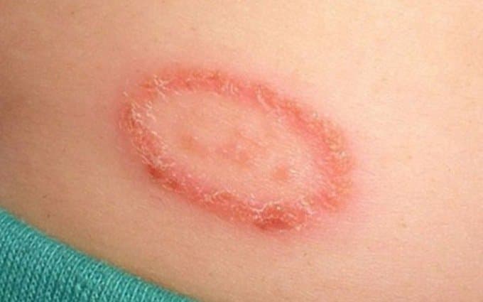 Bệnh zona có tái phát không?