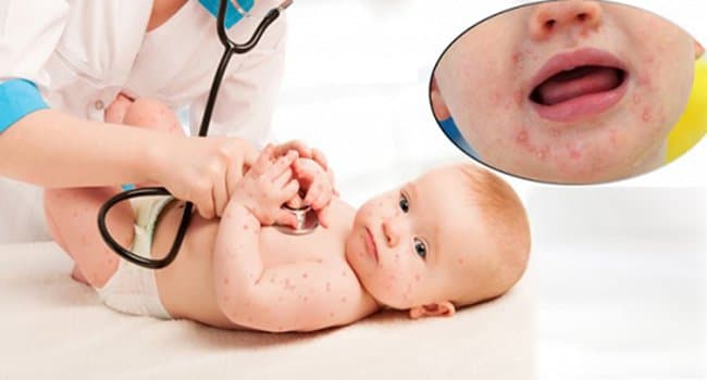 Điều trị bệnh tay chân miệng độ 4 theo hướng dẫn của Bộ Y tế