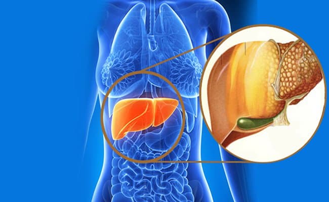 Những Ai dễ mắc bệnh gan nhiễm mỡ không do rượu?