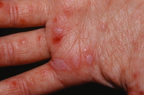 Tay chân miệng là bệnh gì? Dấu hiệu bệnh tay chân miệng ở người lớn