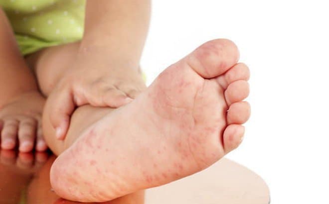 Điều trị bệnh tay chân miệng độ 2 theo hướng dẫn của Bộ Y tế