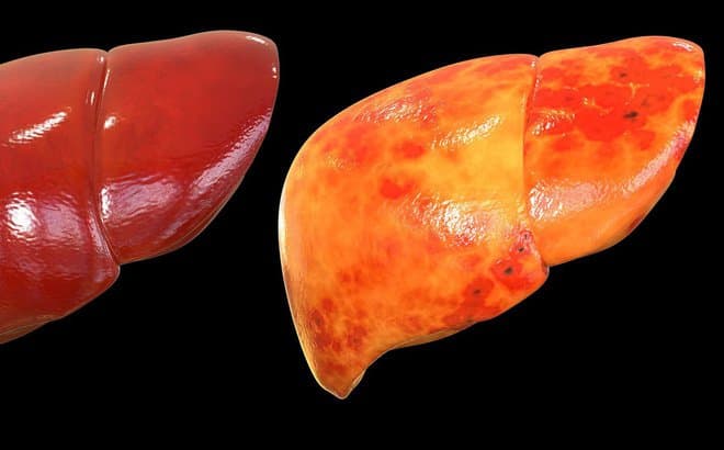 Xét nghiệm chẩn đoán Gan nhiễm mỡ không do rượu