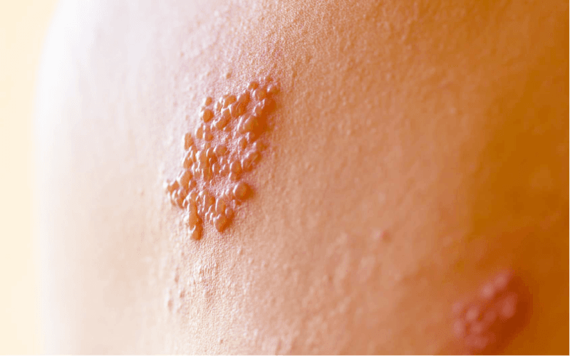 Các vị trí ưa thích của Zona thần kinh