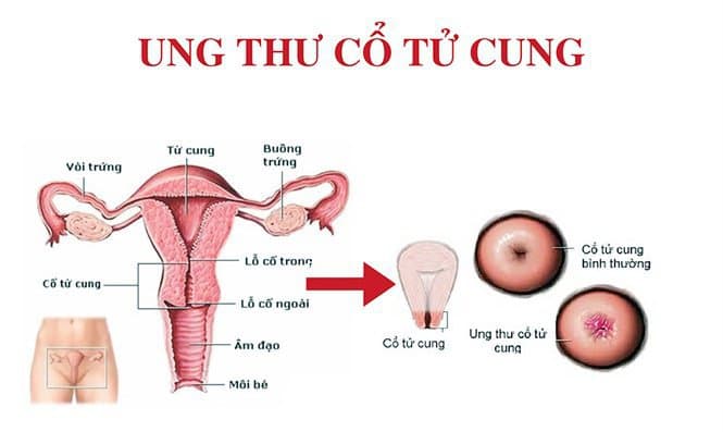 Phương pháp phẫu thuật Wertheim cho bệnh nhân ung thư cổ tử cung giai đoạn sớm