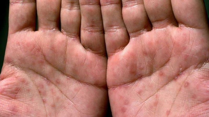 Bệnh Giang mai lây qua đường nào?
