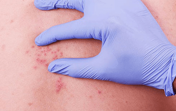 Bệnh zona ở bụng và thần kinh liên sườn: Những điều cần biết
