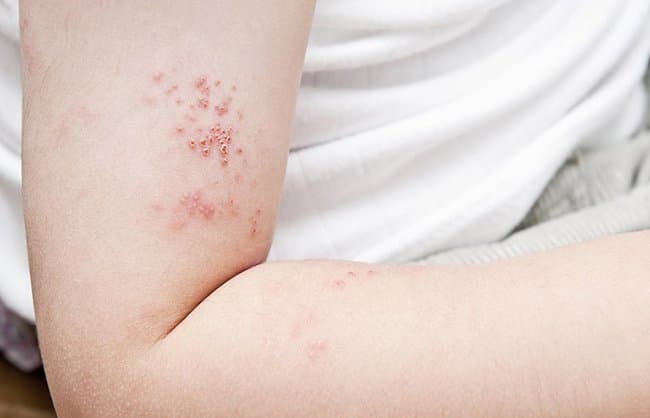 Bệnh Zona thần kinh có để lại sẹo?
