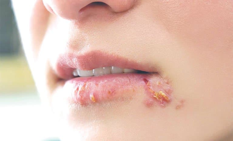 Những đối tượng có nguy cơ cao bị giang mai