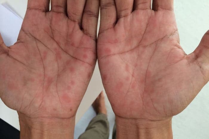 Vi khuẩn listeria là gì? Biểu hiện và Cách điều trị Vi khuẩn listeria