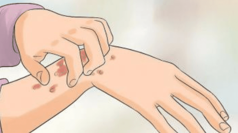 Giang mai giai đoạn 3 những điều cần biết