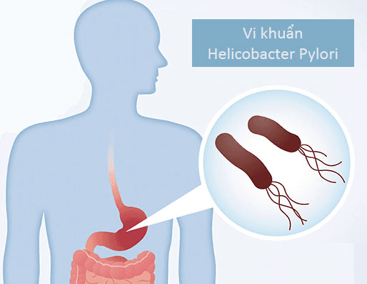 Vi khuẩn HP khi nào sẽ gây ung thư dạ dày?