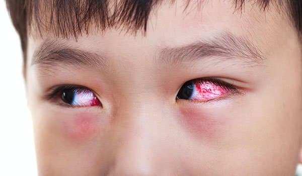 Viêm kết mạc là gì? Nguyên nhân, dấu hiệu nhận biết, triệu chứng và Cách phòng ngừa