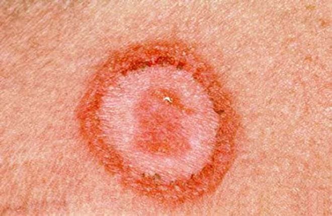 Vi khuẩn giang mai thường xuất hiện ở những chỗ nào?