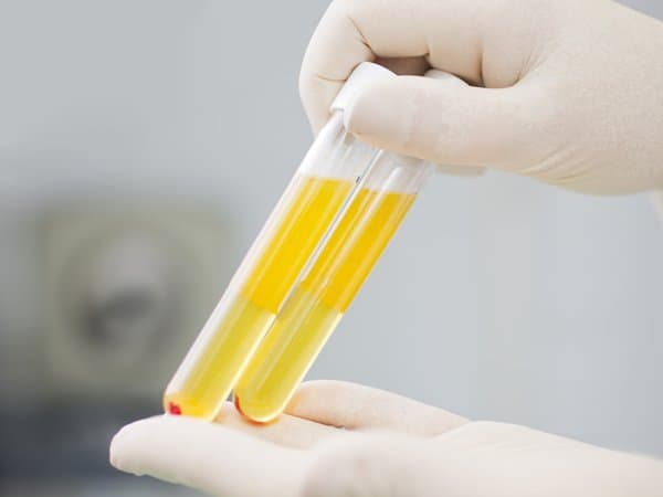 Ý nghĩa của kết quả các xét nghiệm huyết thanh sử dụng cho virus viêm gan B