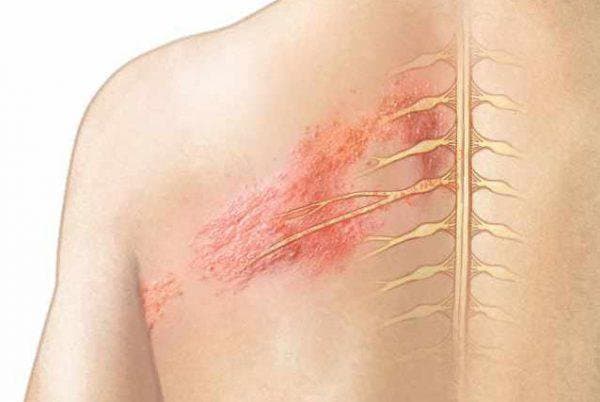 Đau do bị Zona thần kinh: Nguyên nhân, triệu chứng và phòng ngừa