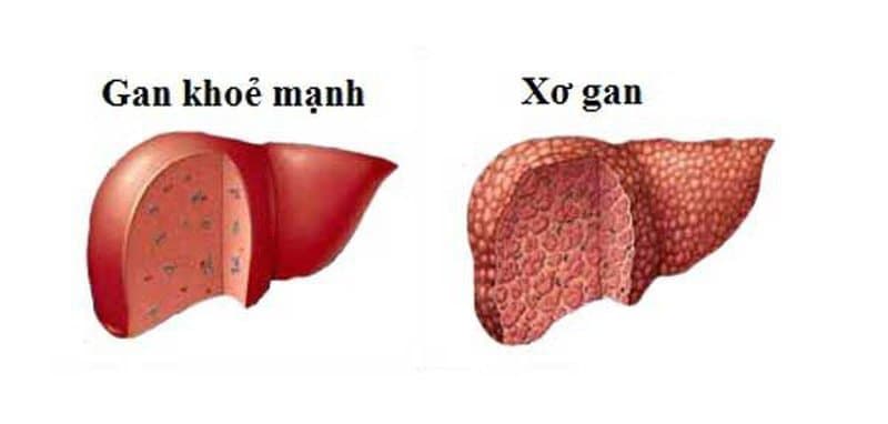 Xơ hóa gan là bệnh gì? Kết quả đo mức độ xơ hóa gan nói lên điều gì?