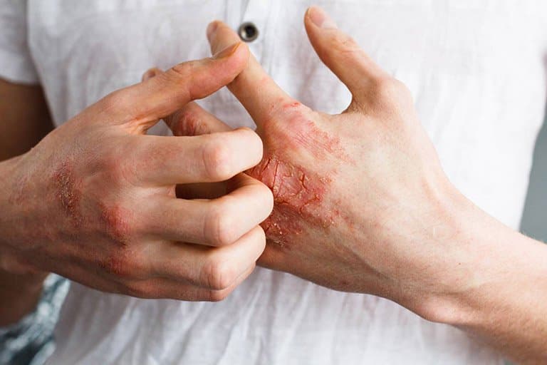 Khi nào thì nên xét nghiệm giang mai nếu có nghi ngờ?