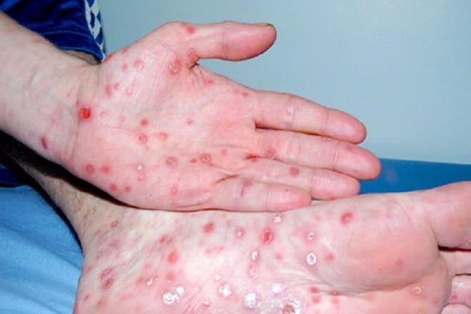 Các biện pháp chẩn đoán bệnh giang mai