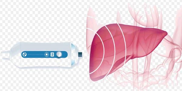 Kết quả đo mức gan nhiễm mỡ sau siêu âm đánh giá xơ hóa gan (Fibrosis)
