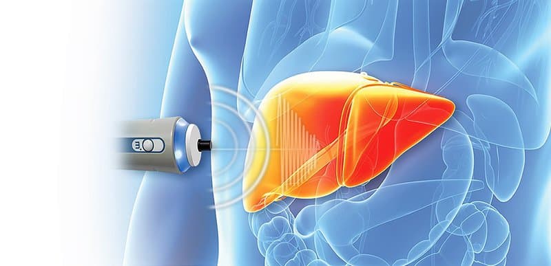 FibroScan đo độ đàn hồi và độ nhiễm mỡ của gan được sử dụng để đánh giá mức độ Xơ gan