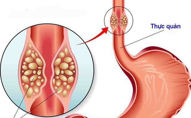 Điều trị thành công ung thư thực quản giai đoạn muộn biến chứng tiêu hóa bằng hóa trị