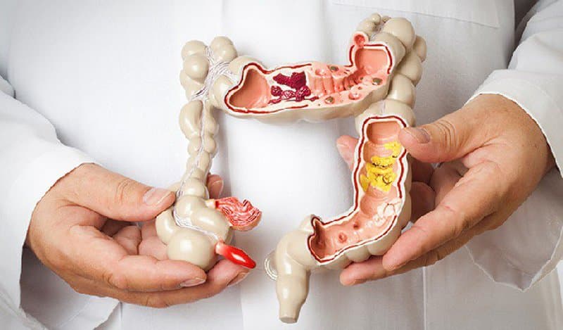 Nang ruột đôi là bệnh gì? và Cách điều trị