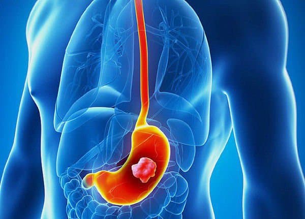 Cắt dạ dày do ung thư: Những điều cần lưu ý
