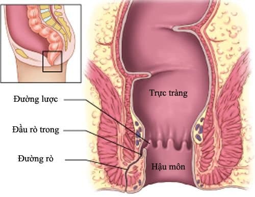 Rò hậu môn tiền đình ở trẻ sơ sinh