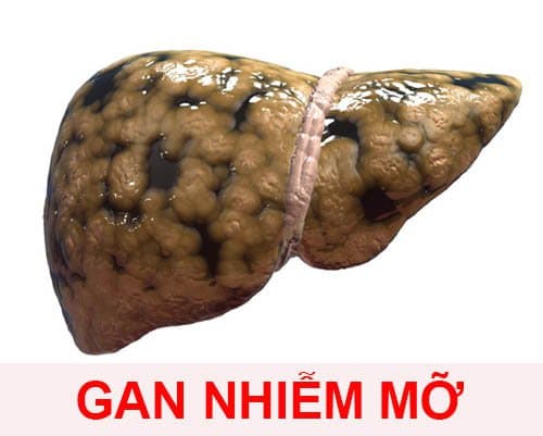 Khỏi bệnh gan nhiễm mỡ nhờ chế độ ăn uống và lối sống lành mạnh