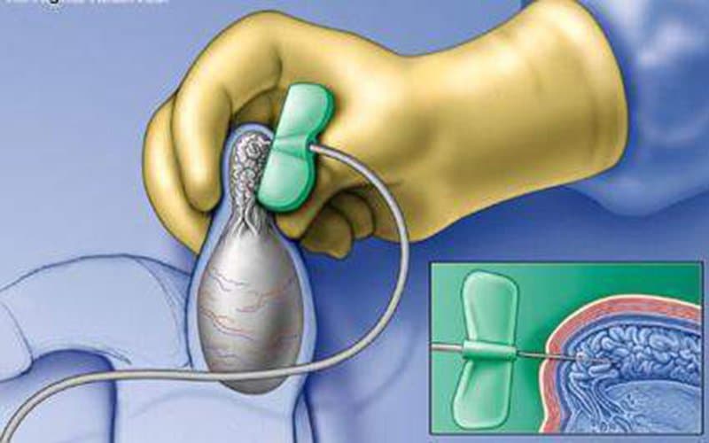 Chọc hút tinh trùng từ mào tinh có đau không?