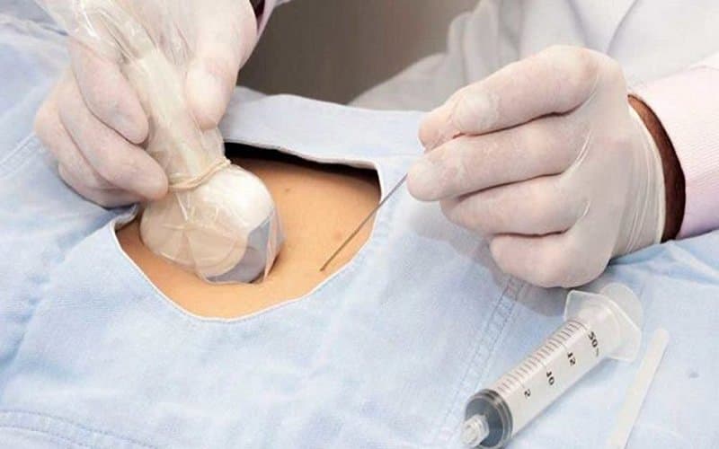 Chọc ối là gì? Thai phụ mắc viêm gan B có nên chọc ối không?