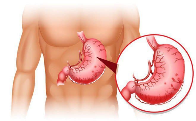 Đau dạ dày ở vị trí nào?