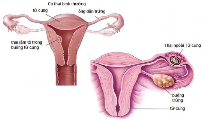 Siêu âm có thể nhìn rõ tình trạng dính buồng tử cung không?