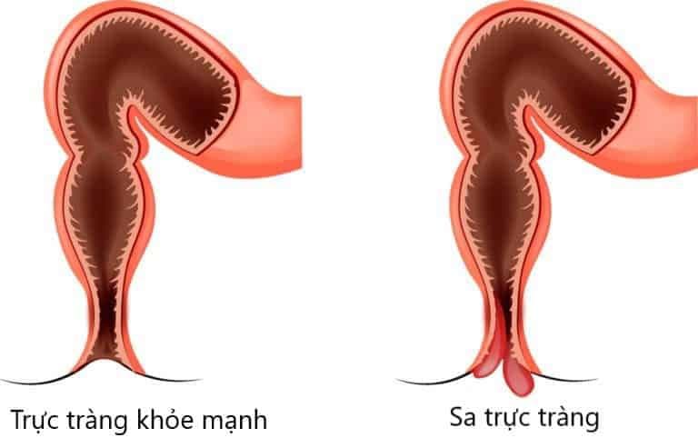 sa trực tràng có những mức độ nào?