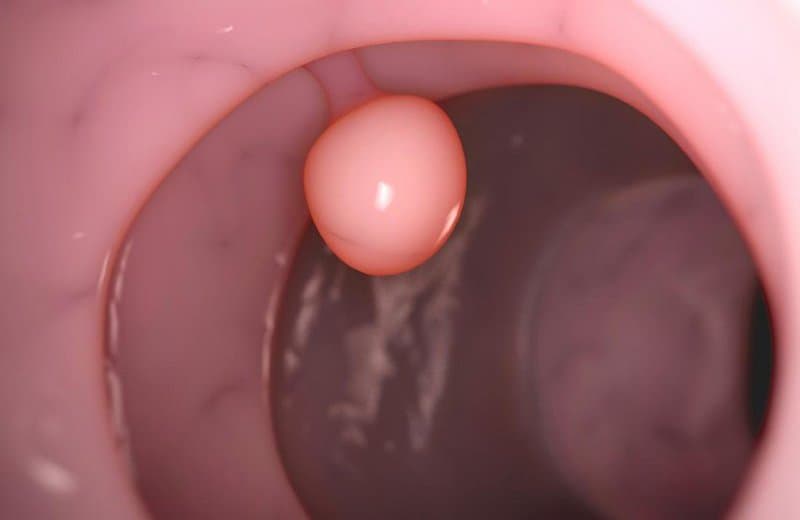 Polyp thực quản: Khi nào cần phẫu thuật?