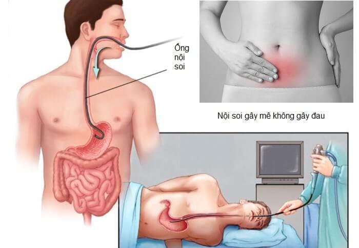 Phác đồ gây mê dạ dày đầy
