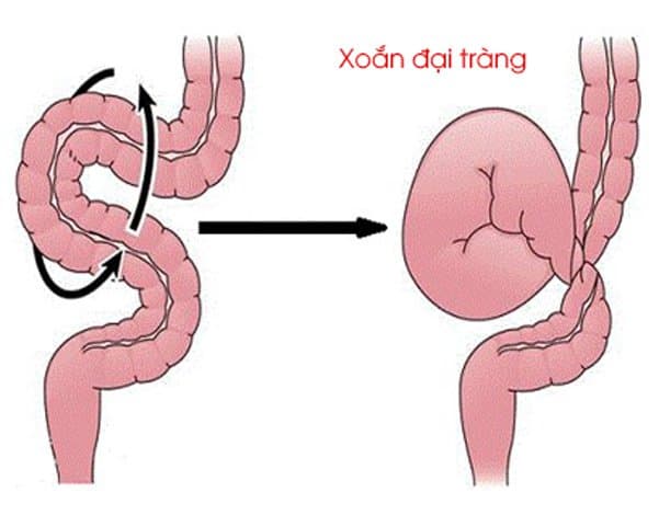 Tìm hiểu về bệnh xoắn đại tràng