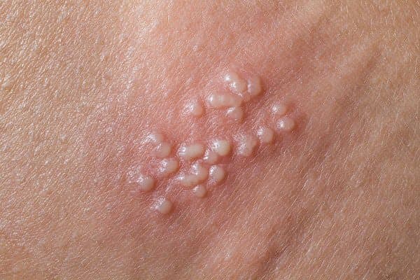 Bị nhiễm HPV gây mụn cóc sinh dục, có nên tiêm ngừa vắc-xin ung thư cổ tử cung?
