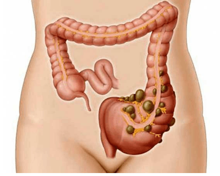 Nhận biết đặc điểm hình ảnh viêm túi thừa cấp trên chụp cắt lớp vi tính