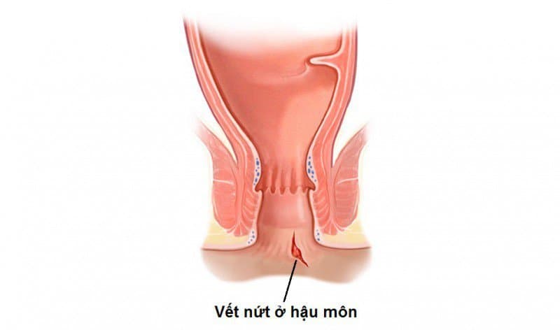 Xử trí vết thương hậu môn trực tràng