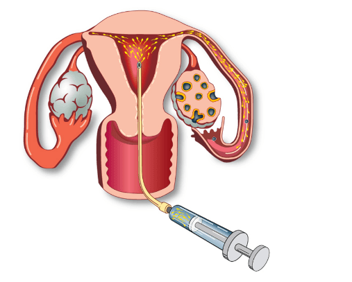 Thụ tinh nhân tạo - Những điều cần biết