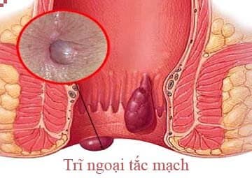 Tắc mạch trĩ là gì? Điều trị như thế nào?